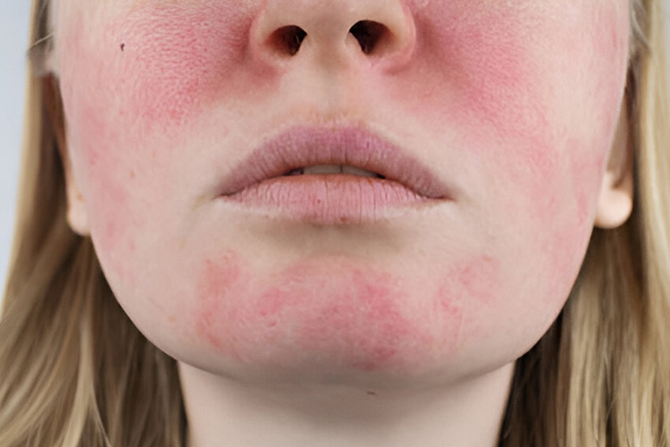 سرخی پروانه ای